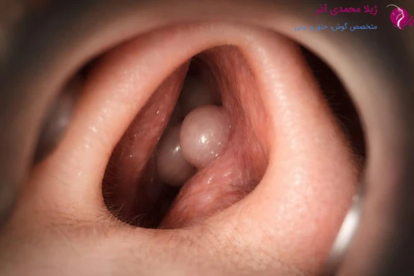 خطرات جراحی پولیپ بینی